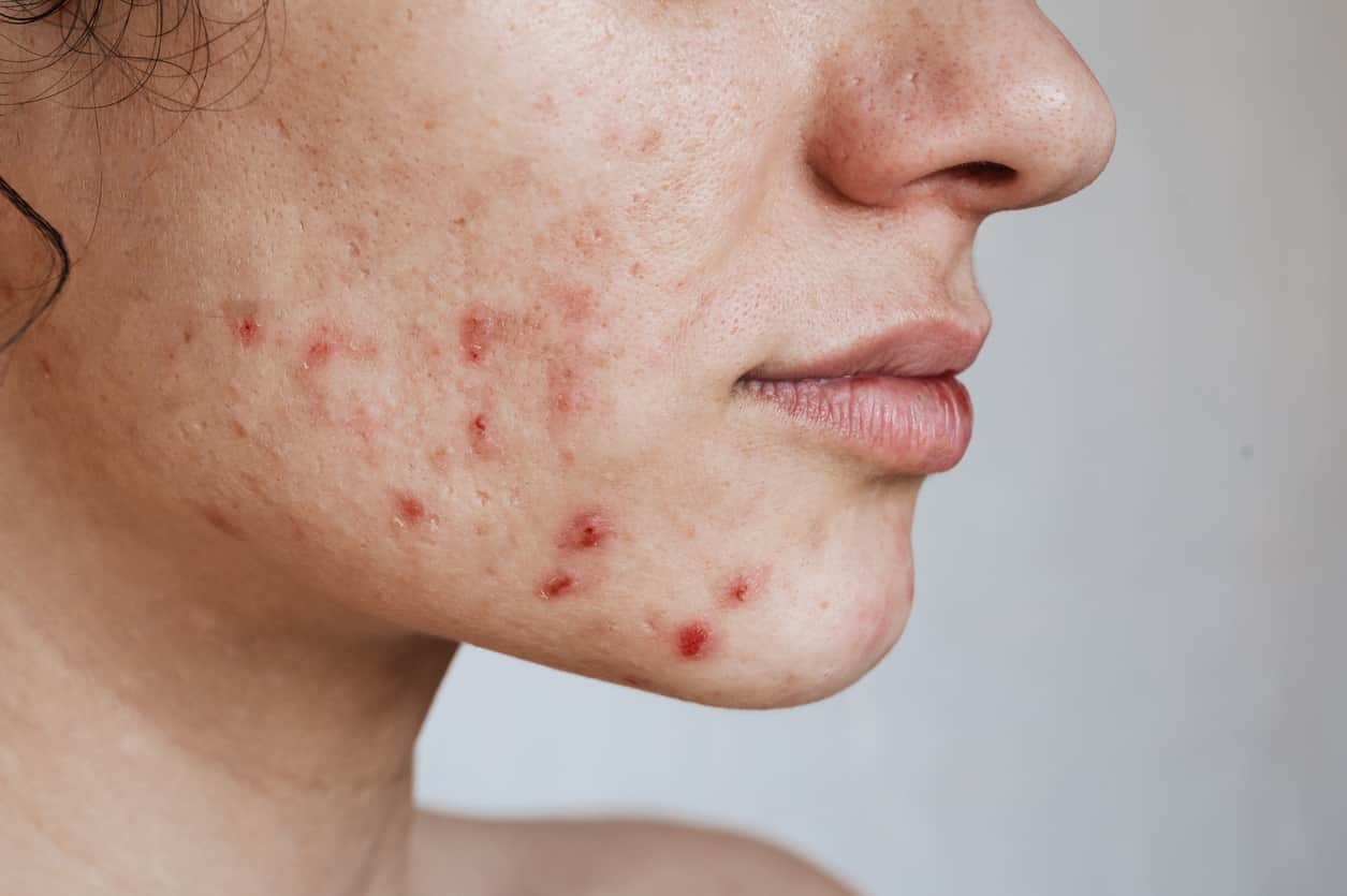 Acné vulgaire et stress oxydatif