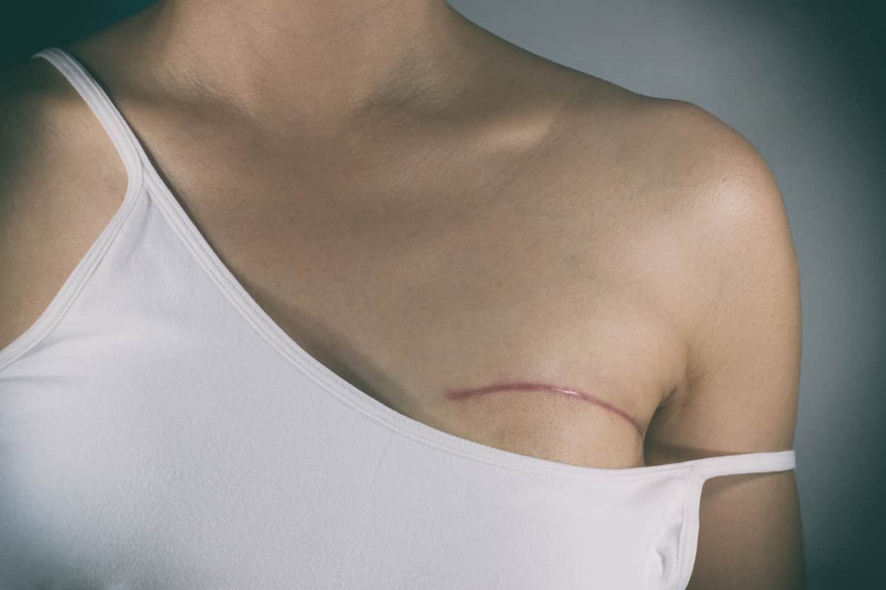 Densité minérale osseuse et cancer du sein