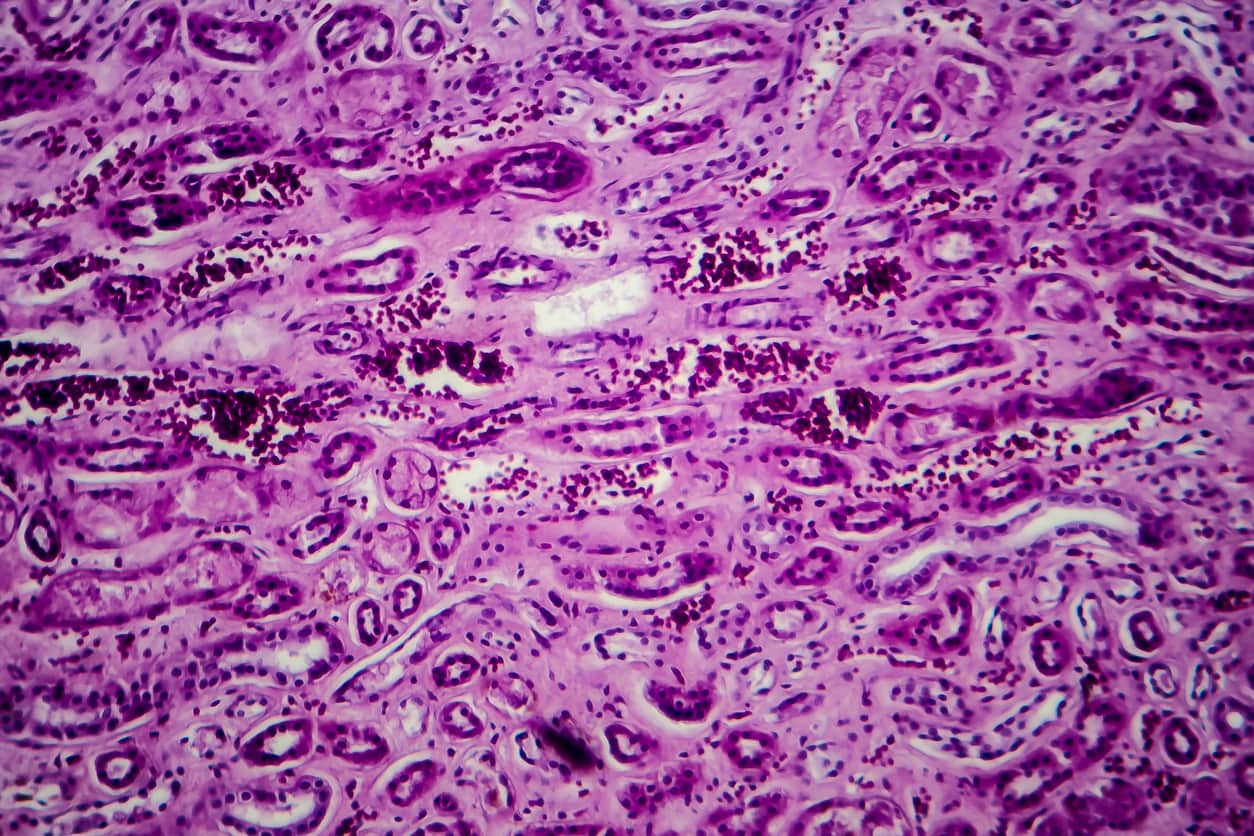 Des lupus érythémateux chimio-induits