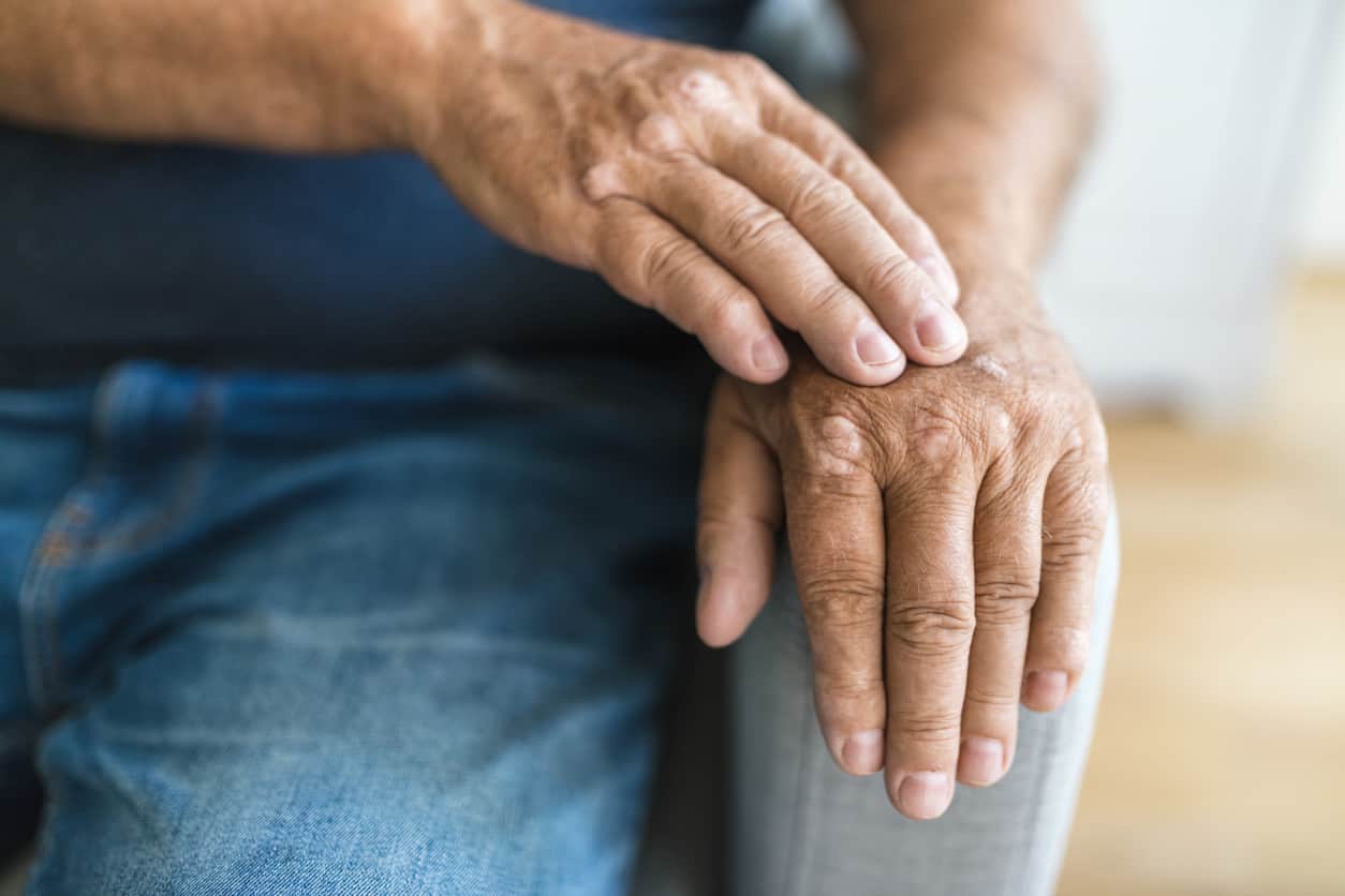 L’impact de la sarcopénie sur l’arthrose
