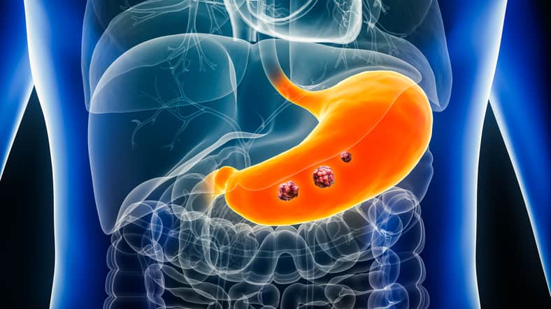 La malnutrition dans le cancer gastrique