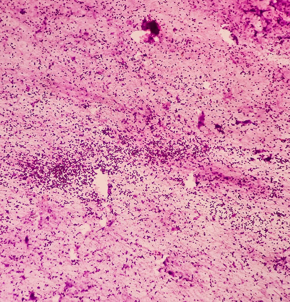 Le batoclimab dans la myasthénie grave