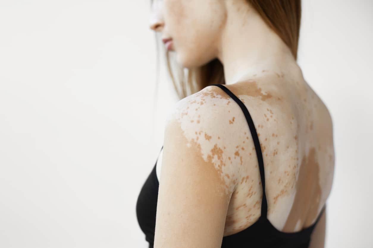 Le tofacitinib dans le vitiligo