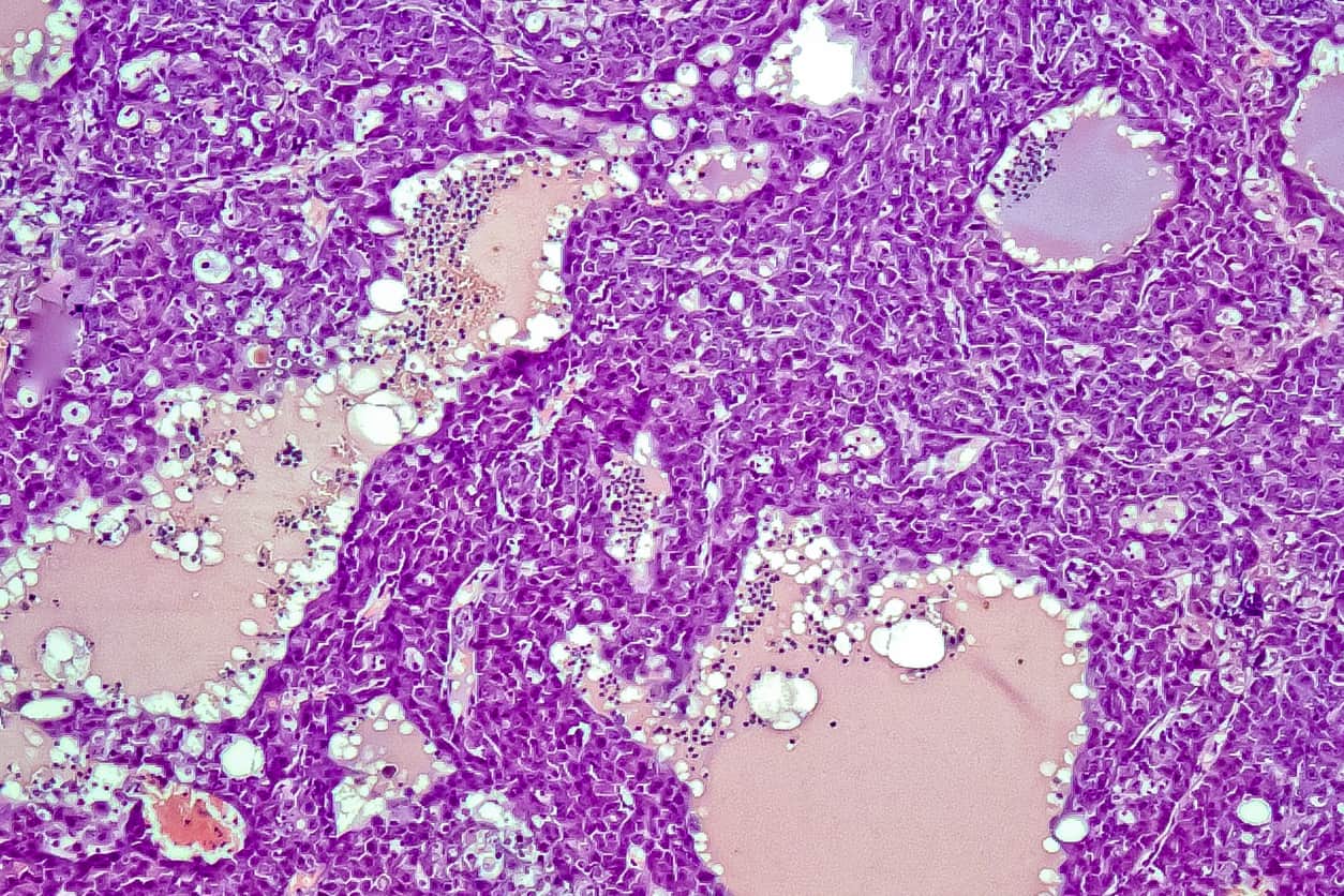 Les spécificités du carcinome hépatocellulaire