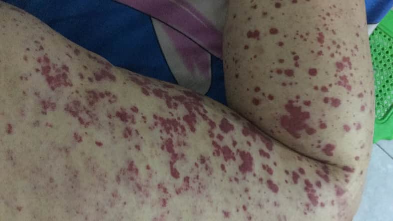 Les vascularites associées aux ANCA