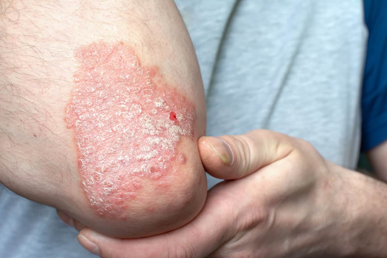 Liens entre psoriasis et santé mentale