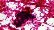 Améliorer le dépistage du carcinome hépatocellulaire secondaire à une stéatose hépatique non alcoolique