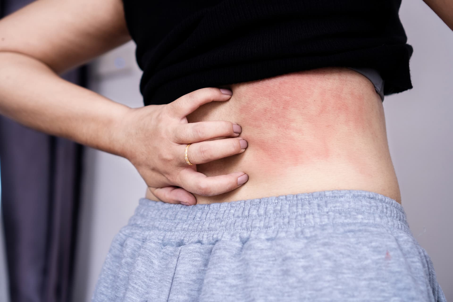 Efficacité et innocuité de l’upadacitinib dans le traitement de la dermatite atopique modérée à sévère chez les adolescents : une revue systématique et une méta-analyse d’essais contrôlés randomisés