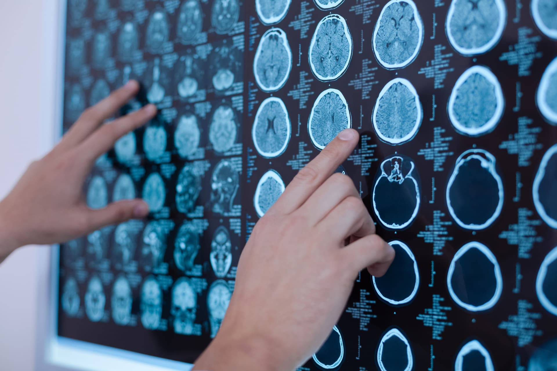 Fièvre et lésions cérébrales aiguës non anoxiques : enjeux cliniques et stratégies d'intervention