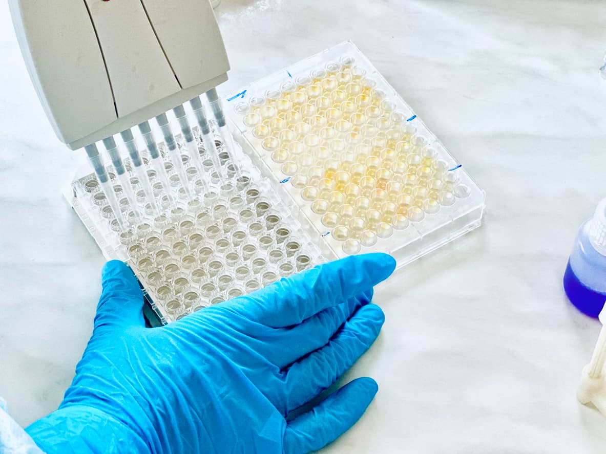 La chaîne légère des neurofilaments comme biomarqueur prometteur pour le diagnostic de la dépression : une revue systématique et une méta-analyse