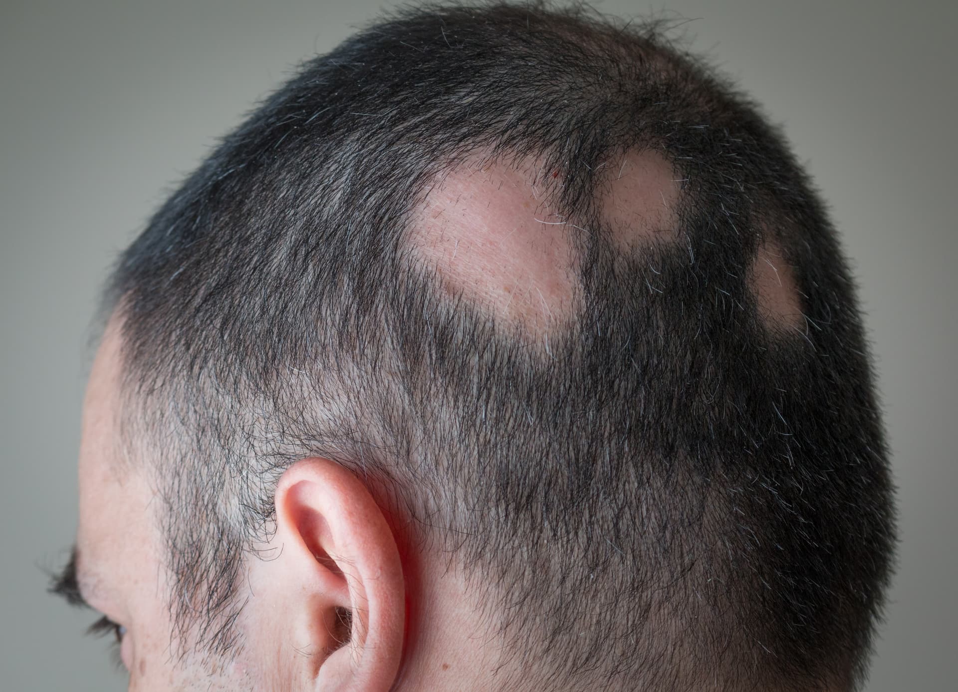 Plant extracts, a natural alternative to existing treatments for hair loss