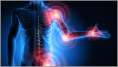 Microbiote, dysfonction de la barrière épithéliale intestinale et polyarthrite rhumatoïde : nouvelles cibles thérapeutiques ?
