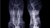 Sténose carotidienne de haut grade asymptomatique : quelle stratégie ?