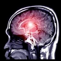 Sténose intracrânienne symptomatique : intérêt de la thérapie endovasculaire vs le traitement médical conventionnel.