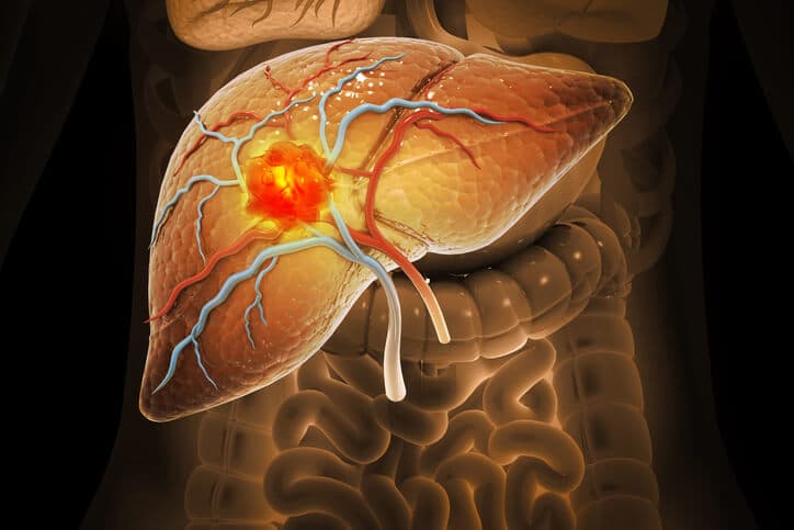 Une revue sur la physiopathologie et la prise en charge du carcinome hépatocellulaire associé à la NASH.