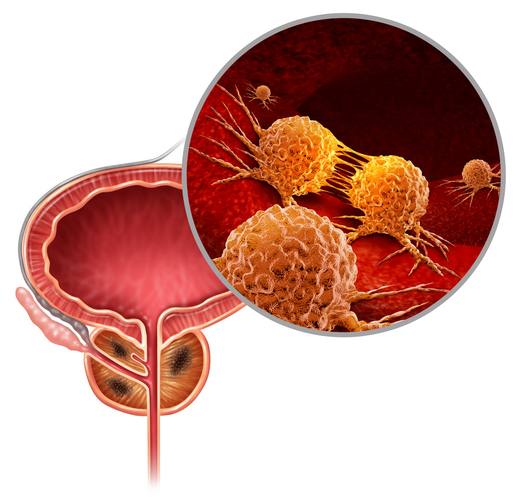 Biomarqueurs inflammatoires dans le cancer de la prostate