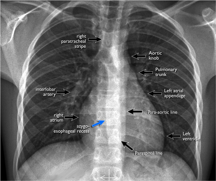 Chest x - ray interpretation by academyofprofessionals