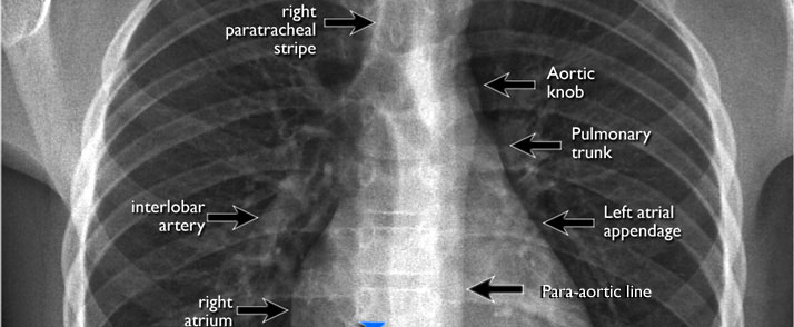 Chest x - ray interpretation