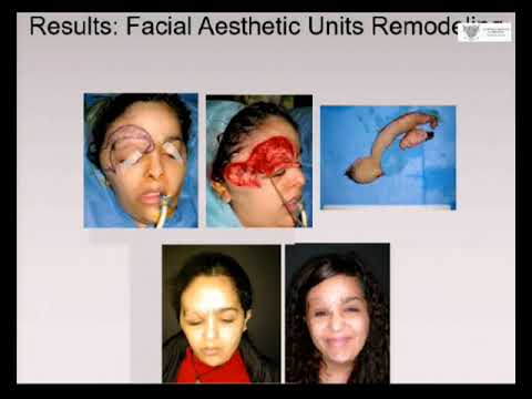 MAXILLO-FACIAL SURGERY AND FACIAL PLASTIC: Replacement surgery during growth