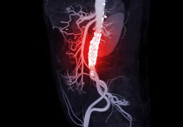 Comment limiter la croissance et la rupture de l’anévrisme de l’aorte abdominale ? Comment limiter la croissance et la rupture de l’anévrisme de l’aorte abdominale ?
