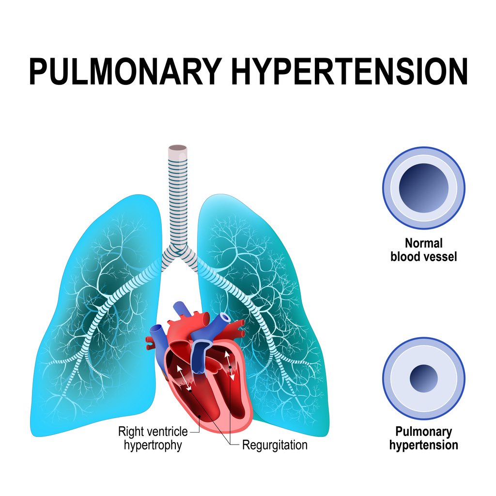 Hypertension pulmonaire, un modèle animal pour mieux l’étudier Hypertension pulmonaire, un modèle animal pour mieux l’étudier