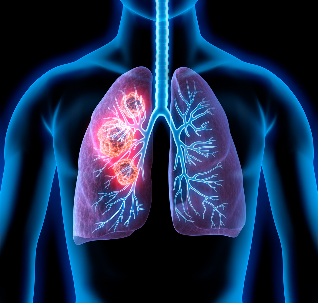 L’IA dans le cancer du poumon non à petites cellules L’IA dans le cancer du poumon non à petites cellules
