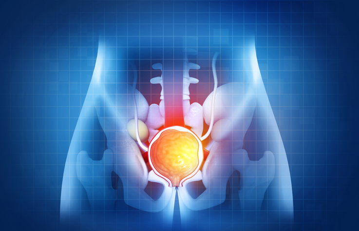 La ferroptose, un mécanisme clé dans les traitements anti-androgènes du cancer de la prostate La ferroptose, un mécanisme clé dans les traitements anti-androgènes du cancer de la prostate