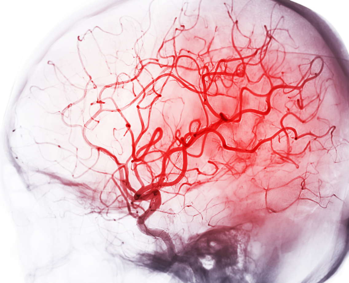 Remote ischemic conditioning in acute ischemic stroke Remote ischemic conditioning in acute ischemic stroke