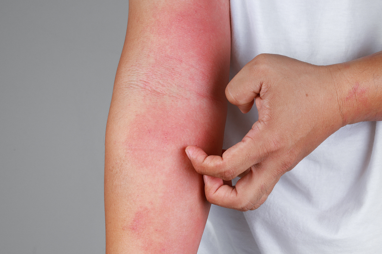 Le dupilumab dans l’urticaire chronique spontanée Le dupilumab dans l’urticaire chronique spontanée