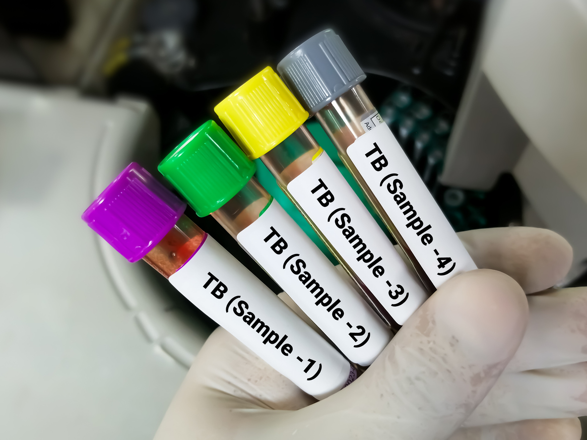 The burden of tuberculosis in adolescents and young adults The burden of tuberculosis in adolescents and young adults