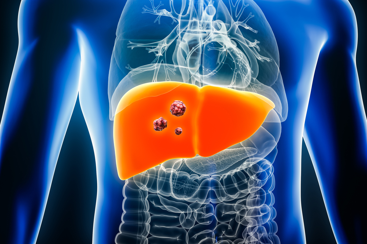Le lenvatinib dans le carcinome hépatocellulaire du patient très âgé Le lenvatinib dans le carcinome hépatocellulaire du patient très âgé