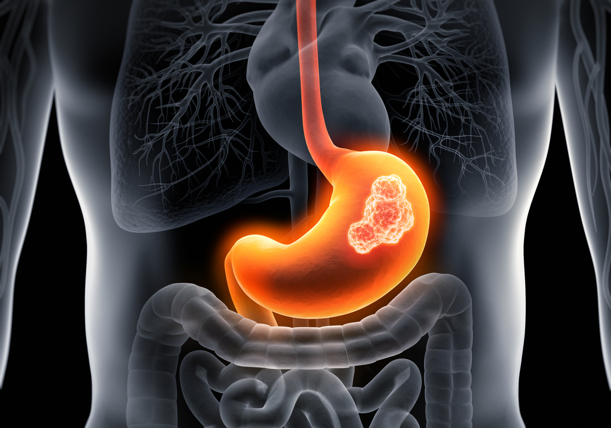 Le rôle de Streptococcus anginosus dans la progression des tumeurs gastriques Le rôle de Streptococcus anginosus dans la progression des tumeurs gastriques