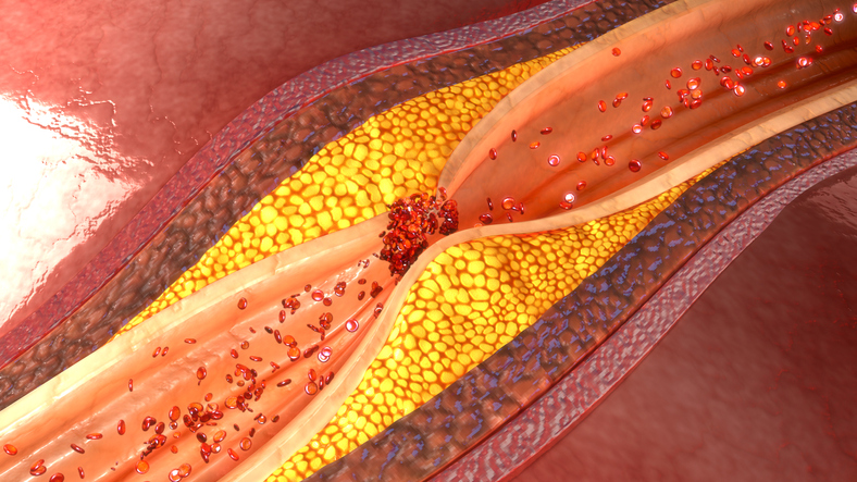 Le rôle des vésicules extracellulaires dans l’évolution des maladies cardiovasculaires. Le rôle des vésicules extracellulaires dans l’évolution des maladies cardiovasculaires.
