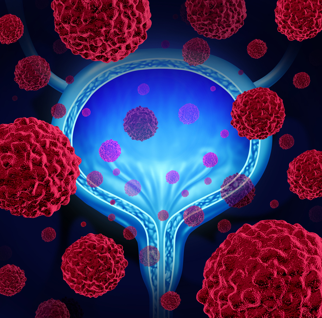 The IL-1 signaling pathway in bladder cancer The IL-1 signaling pathway in bladder cancer