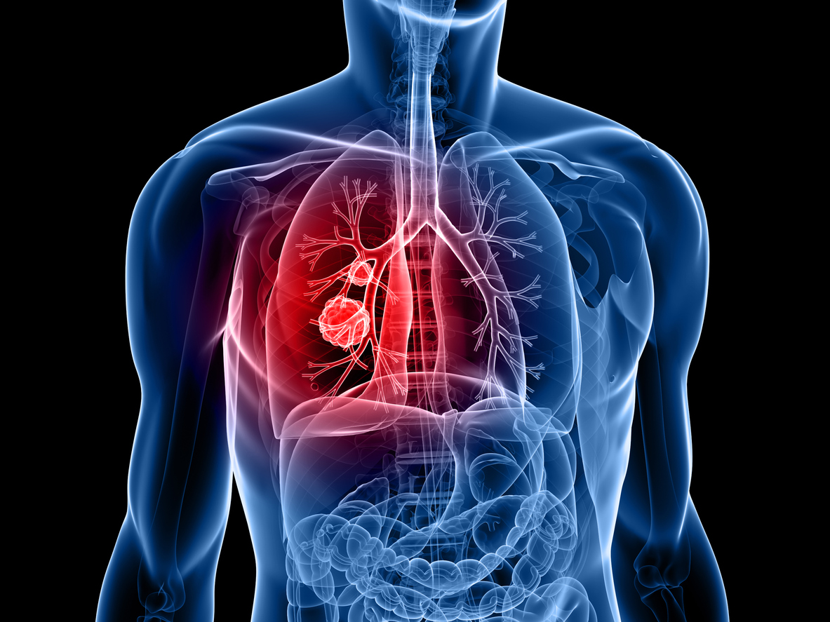Les agonistes des récepteurs de l’acide rétinoïque pour augmenter la réponse des points de contrôle immunitaire dans les cancers Les agonistes des récepteurs de l’acide rétinoïque pour augmenter la réponse des points de contrôle immunitaire dans les cancers