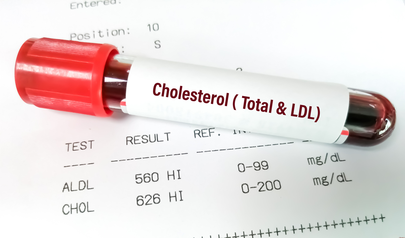 Lien entre le HDL-cholestérol et le risque de dépression Lien entre le HDL-cholestérol et le risque de dépression
