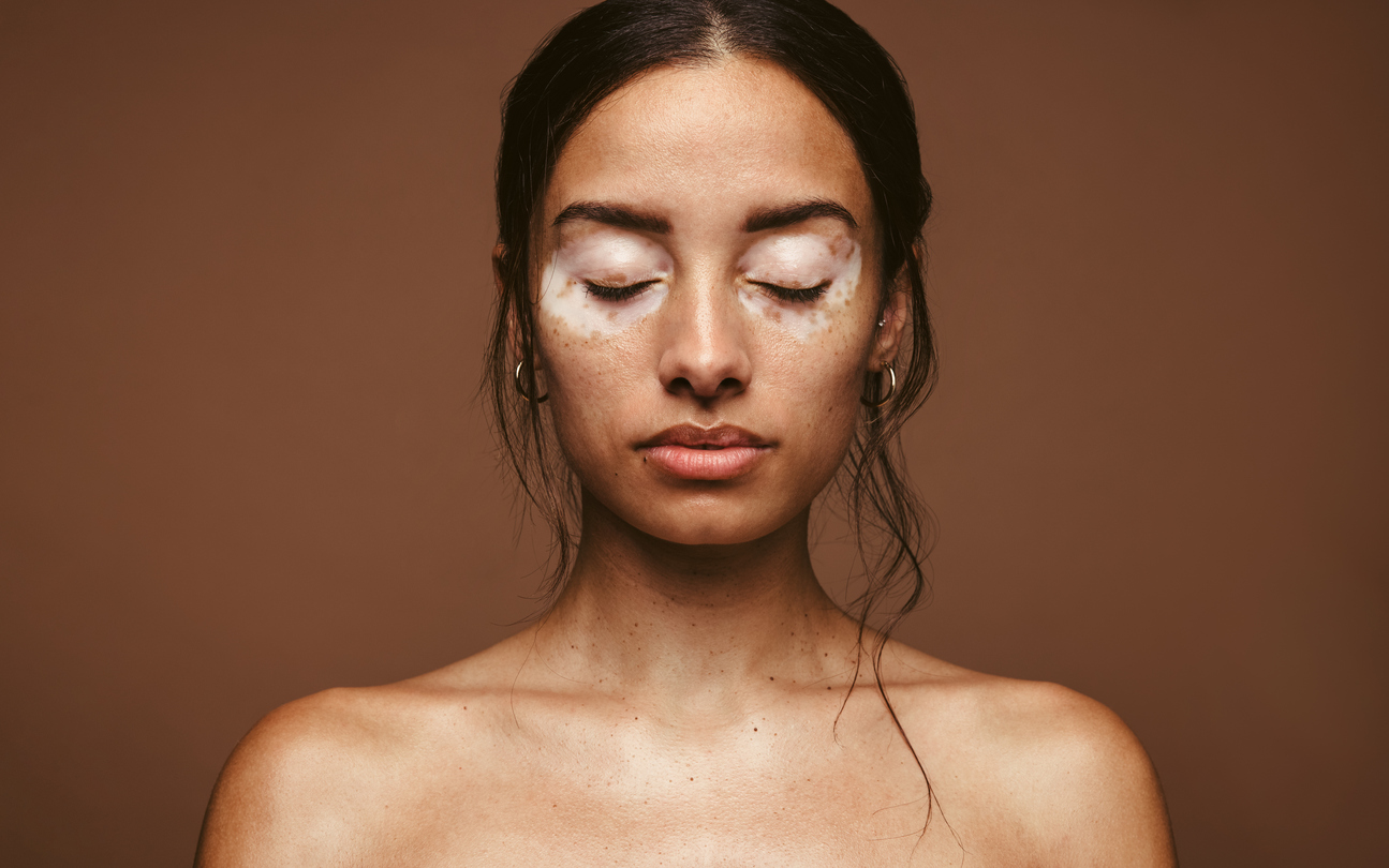 NB-UVB: light that heals?