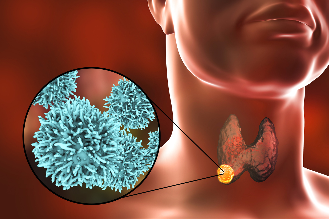 Predicting lesion volume in primary hyperparathyroidism