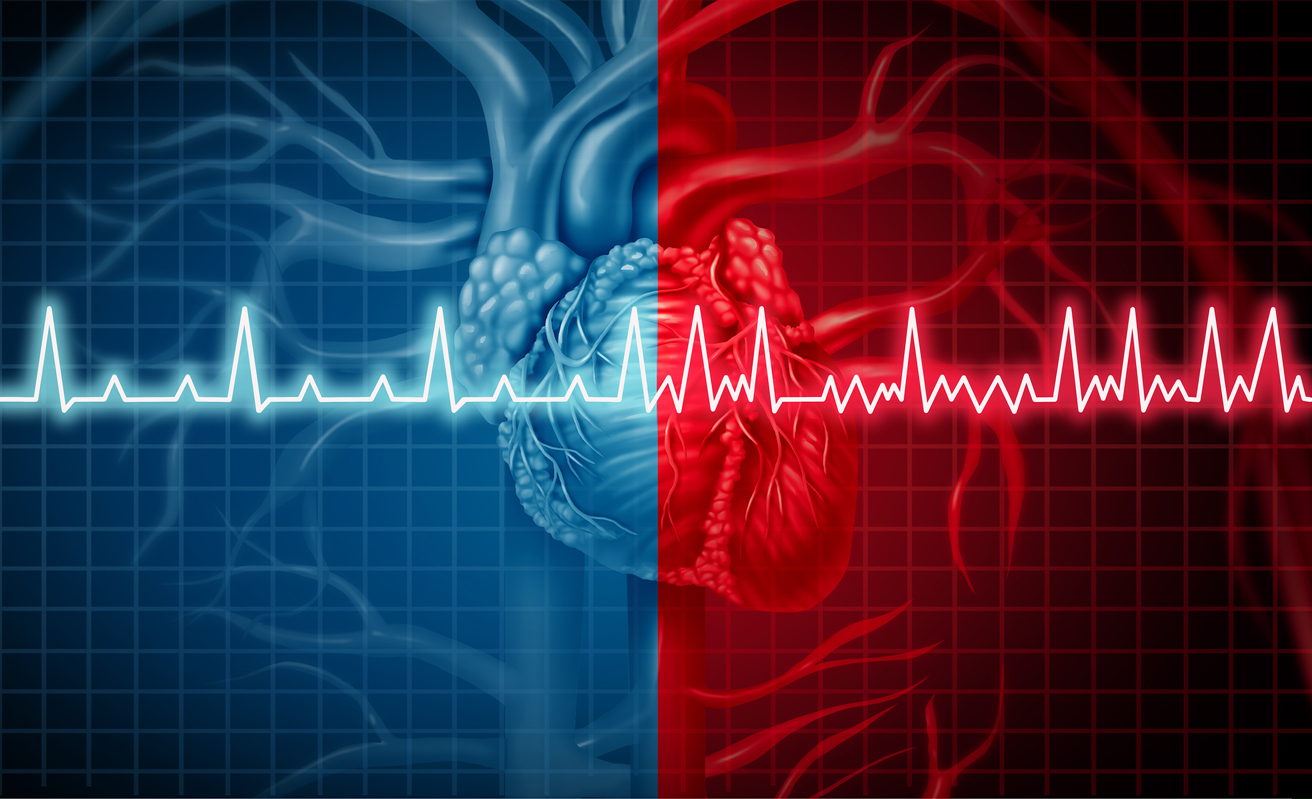 What anticoagulant therapy is required after stenting in patients with atrial fibrillation? What anticoagulant therapy is required after stenting in patients with atrial fibrillation?