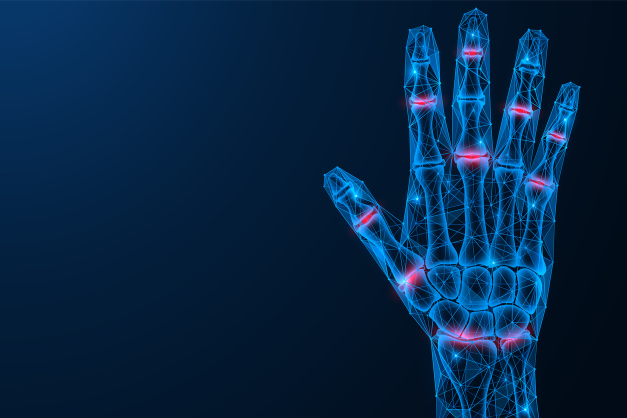 Psoriatic arthritis of the hand and nail psoriasis Psoriatic arthritis of the hand and nail psoriasis