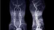 Sténose carotidienne de haut grade asymptomatique : quelle stratégie thérapeutique ? Sténose carotidienne de haut grade asymptomatique : quelle stratégie thérapeutique ?