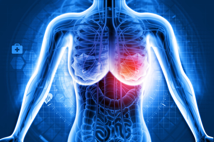 Un nomogramme pronostique pour les patientes atteintes d’un cancer du sein avec métastases osseuses Un nomogramme pronostique pour les patientes atteintes d’un cancer du sein avec métastases osseuses