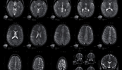 Une IRM cérébrale systématique en cas d’HTA maligne ?