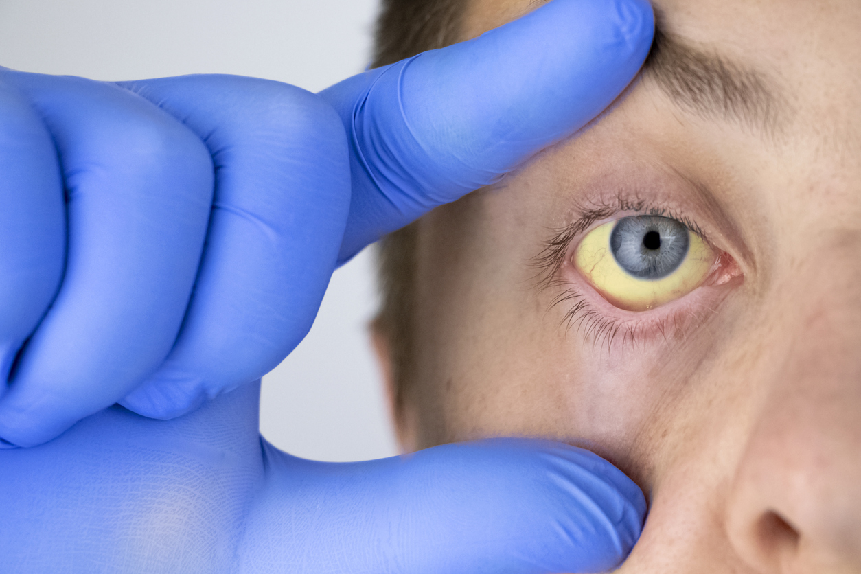 Une thérapie génique dans le syndrome de Crigler-Najjar Une thérapie génique dans le syndrome de Crigler-Najjar