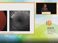 02 - Atrofia Geográfica