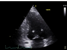 2-D Echocardiographic Morphology of End-Diastolic and End-Systolic Volume