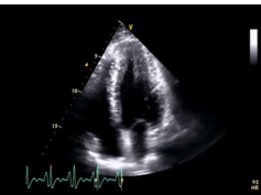 2-D Echocardiographic Morphology of Left Ventricular Strain Patterns