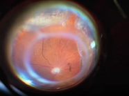 23 G PPV with Massive Circular Uveal Effusion A Small Cut