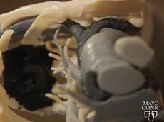 3D Printing of Patients' Anatomy Aids in Surgical Planning