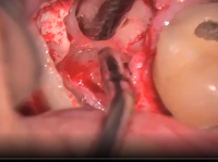 73 year-old female patient complicated 3rd molar